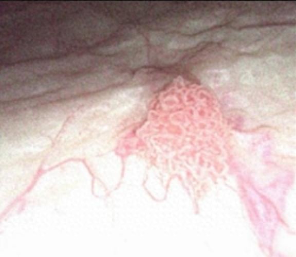 尿液出现这个变化千万注意!可能是癌症信号!-腾渊科技论坛