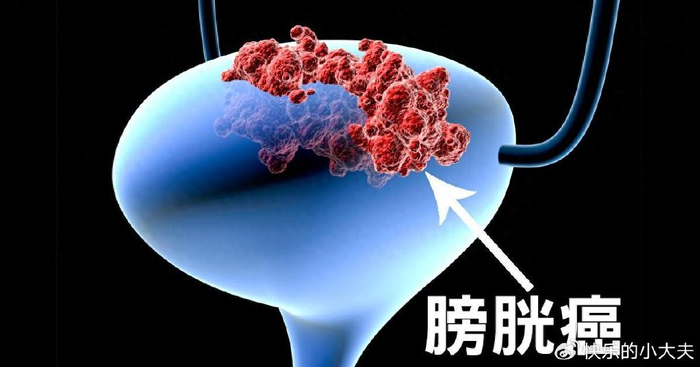 长期吸烟,是膀胱癌高风险人群!做好早期筛查,早发现早治疗-腾渊科技论坛