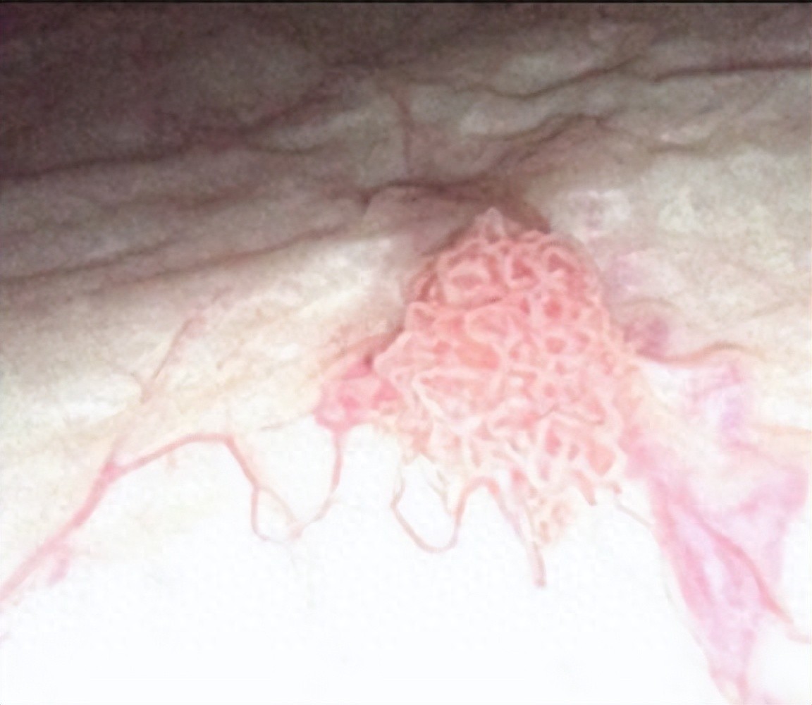 【“医”说就懂】出现这种颜色的尿要当心，可能是癌症前兆！-腾渊科技论坛