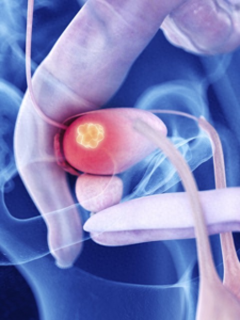 膀胱癌恶化进展的相关提示指标及临床应用价值-腾渊科技论坛