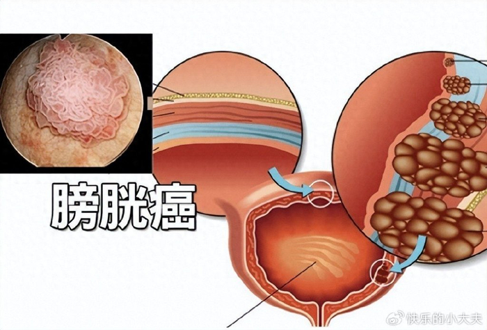 约一半膀胱癌患者因长期吸烟,远离这7个因素,做好早期预防-腾渊科技论坛